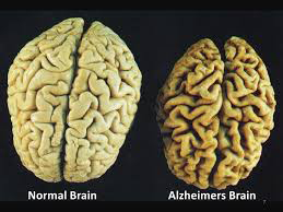 This picture shows a normal brain and a brain with Alzheimer’s disease. 